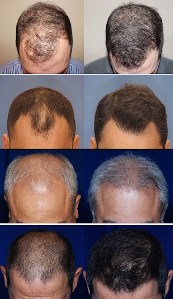Alpha Male Enhancement and Hair Restoration