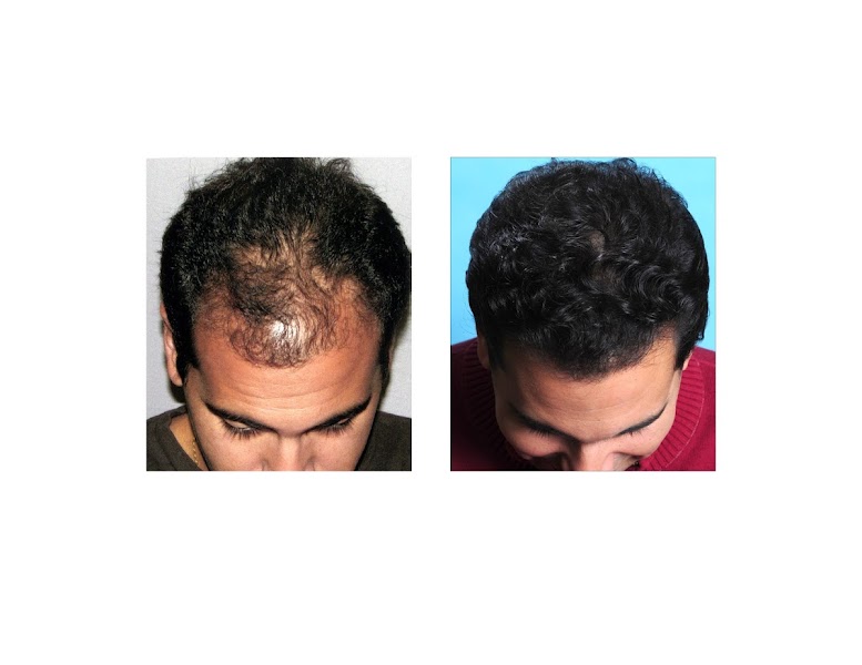 Bosley - Hair Restoration & Transplant