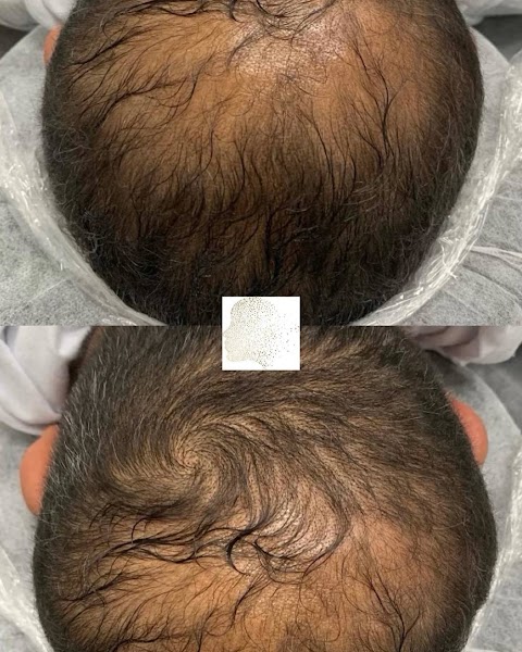 Dermesthetica Scalp Micropigmentation and Combo Eyebrows